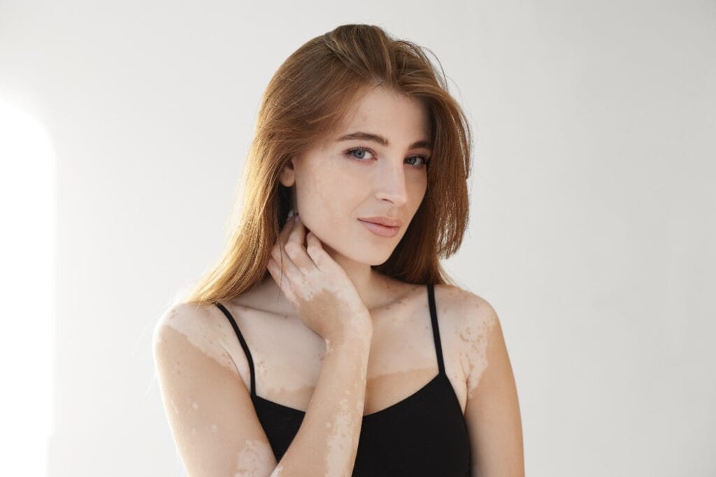 Vitiligo cada vez mais perto do tratamento