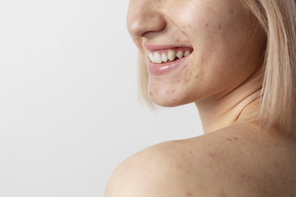 Sem receitas caseiras: tratamentos que eliminam cicatrizes de acne