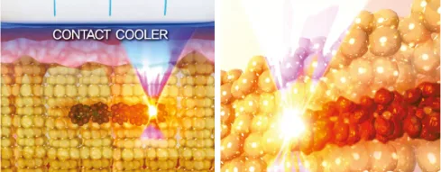 Fase Inflamatória de Scizer