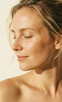 Melasma