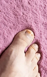 Fungoide Onicomicose