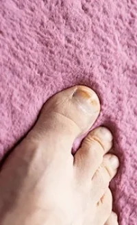 Fungoide Onicomicose