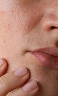 Lesões Pigmentares Benignas